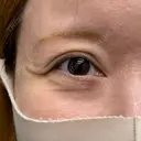 下まぶたたるみ取り / その他（目元） ネビュラクリニック 京都院 BEFORE サムネイル用