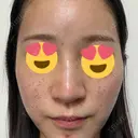 ピコレーザートーニング（美白・肝斑） / ピコフラクショナルレーザー（毛穴・ニキビ跡） / ピコスポット 東京シルククリニック 東京神田院 BEFORE サムネイル用