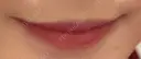 ヒアルロン酸注入（唇） 目白ホワイトクリニック BEFORE サムネイル用
