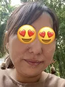 糸リフト BON BON CLINIC 銀座駅前本院 BEFORE サムネイル用