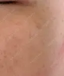 ルメッカ Clinic K Blossom BEFORE サムネイル用