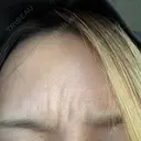 ボトックス（あご） / ボトックス（眉間） / ボトックス（目尻） / ボトックス（額） TCB東京中央美容外科 名古屋栄院 BEFORE サムネイル用