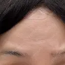 ボトックス（目尻） / ボトックス（額） ルラ美容クリニック 千葉院 / ルラスキンクリニック 千葉院 BEFORE サムネイル用