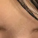 ボトックス（眉間） DMTC CLINIC 渋谷院 BEFORE サムネイル用