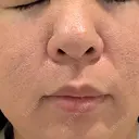 ニキビ治療 AB美容クリニック 新宿院 BEFORE サムネイル用