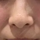 エレクトロポレーション / レーザートーニング（美白・かんぱん） トラスト美容クリニック 銀座院 BEFORE サムネイル用