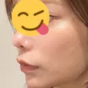 ヒアルロン酸注入（鼻翼基部） KIMI CLINIC 形成・美容外科 BEFORE サムネイル用