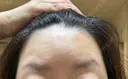 ボトックス（エラ・小顔） / マイクロボトックス / ボトックス（眉間） 札幌美容外科ネビュラクリニック BEFORE サムネイル用