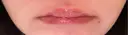ヒアルロン酸注入（唇） 目白ホワイトクリニック BEFORE サムネイル用