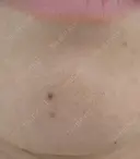 ほくろ・いぼ除去レーザー（肌） プライベートスキンクリニック 梅田本院 BEFORE サムネイル用