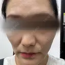 ピコレーザートーニング（美白・肝斑） / ピコフラクショナルレーザー（毛穴・ニキビ跡） 東京シルククリニック 新宿院 BEFORE サムネイル用