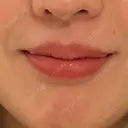 ヒアルロン酸注入（唇） 目白ホワイトクリニック BEFORE サムネイル用