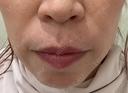 PRP皮膚再生療法 共立美容外科 名古屋院 BEFORE サムネイル用