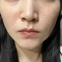 ルメッカ L‘amour clinic Tokyo【ラムールクリニック東京】 BEFORE サムネイル用