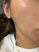 光治療（フォトフェイシャルなど） B-LINE CLINIC 大阪院 BEFORE サムネイル用
