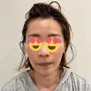 切開リフト GRACY TOKYO CLINIC【グレイシートウキョウクリニック】 BEFORE サムネイル用