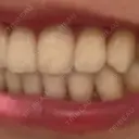 ホワイトニング LEAGRANT CLINIC 中目黒 BEFORE サムネイル用