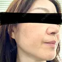 ルメッカ 東京シルククリニック 東京神田院 BEFORE サムネイル用