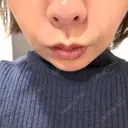 ヒアルロン酸注入（頬） ギャラリークリニック 横浜院 BEFORE サムネイル用