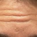ボトックス（額） FIG CLINIC BEFORE サムネイル用