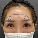 脂肪注入（額） plume clinic BEFORE サムネイル用