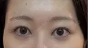 二重埋没 / 目尻切開 / 自然癒着法 Stand by Beauty Clinic BEFORE サムネイル用