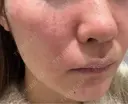 エレクトロポレーション / 毛穴洗浄（ハイドラフェイシャルなど） ウィルビークリニック 新宿院 BEFORE サムネイル用