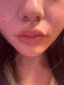 ヒアルロン酸注入（唇） 目白ホワイトクリニック BEFORE サムネイル用