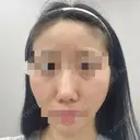 鼻尖形成（切開） / 鼻中隔延長（切開） / 軟骨移植 / 骨切幅寄せ / ワシ鼻修正・ハンプ切除 / 斜鼻修正 / 鼻修正 リッツ美容外科 東京院 BEFORE サムネイル用