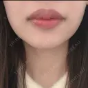 ヒアルロン酸注入（唇） TCB東京中央美容外科 青森院 BEFORE サムネイル用