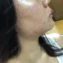 ニキビ治療 たにまちクリニック BEFORE サムネイル用