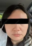 糸リフト / 脂肪吸引（顔） / 下まぶたの脂肪取り / 脂肪注入（額） / メーラーファット除去 / 脂肪注入（目の下） SEA CLINIC（シークリニック） BEFORE サムネイル用