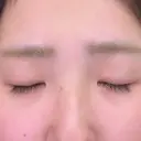 二重埋没 / その他（目元） 湘南美容クリニック 福島院 BEFORE サムネイル用
