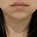 ヒアルロン酸注入（唇） 目白ホワイトクリニック BEFORE サムネイル用