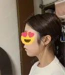 脂肪吸引（顔） / 下まぶたの脂肪取り 東京脂肪吸引クリニック BEFORE サムネイル用