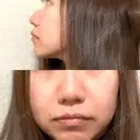 鼻尖形成（切開） / 小鼻縮小（切開） / 軟骨移植 ASTRA BEAUTY CLINIC BEFORE サムネイル用
