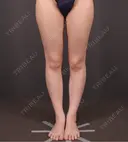 脂肪吸引（脚） / 豊胸（脂肪注入） GRACIA clinic 【グラシアクリニック】 BEFORE サムネイル用