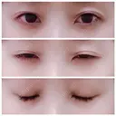 二重埋没 / 眼瞼下垂（切開） / クマ治療 / 下まぶたの脂肪取り THE MEDICAL SALON BEFORE サムネイル用