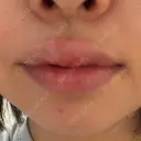 肌ヒアルロン酸注入（たるみ・シワ改善） / シワ取りボトックス / RF（高周波）たるみ治療 東京シルククリニック 東京神田院 BEFORE サムネイル用