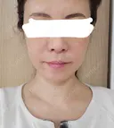 美容点滴・美容注射（美肌） / 美容点滴・美容注射（疲労回復） / ピーリング（ニキビ・毛穴） / イオン導入 / エレクトロポレーション / ピーリング（ハリ・ツヤ） oneUPclinic BEFORE サムネイル用
