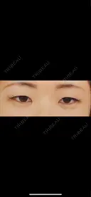 二重埋没 城本クリニック 姫路院 BEFORE サムネイル用