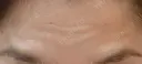 ボトックス（眉間） / ボトックス（目尻） / ボトックス（額） DMTC美容皮膚科 大宮院 BEFORE サムネイル用