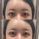 肌ヒアルロン酸注入（たるみ・シワ改善） しのぶ皮膚科 BEFORE サムネイル用