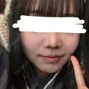 メーラーファット除去 4Dクリニック BEFORE サムネイル用