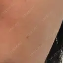 ピコレーザートーニング（美白・肝斑） / ピコフラクショナルレーザー（毛穴・ニキビ跡） おおかみ美容のクリニック 新宿院 BEFORE サムネイル用