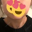 ボトックス（エラ・小顔） DMTC CLINIC 渋谷院 BEFORE サムネイル用