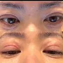 二重埋没 KIMI CLINIC 形成・美容外科 BEFORE サムネイル用