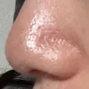 毛穴洗浄（ハイドラフェイシャルなど） 心斎橋KT美容クリニック BEFORE サムネイル用