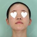 隆鼻術 / 軟骨移植 / 鼻尖形成（非切開） / 鼻中隔延長（非切開） WOM CLINIC GINZA （ワム クリニック ギンザ） BEFORE サムネイル用