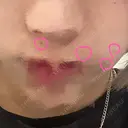 ほくろ・いぼ切除（肌） 心斎橋KT美容クリニック BEFORE サムネイル用